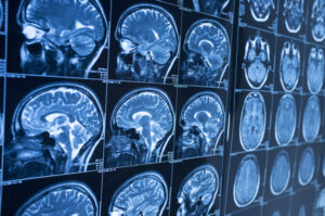 What is a Traumatic Brain Injury?